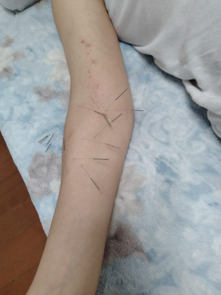 皮膚症状に対する鍼施術の例
