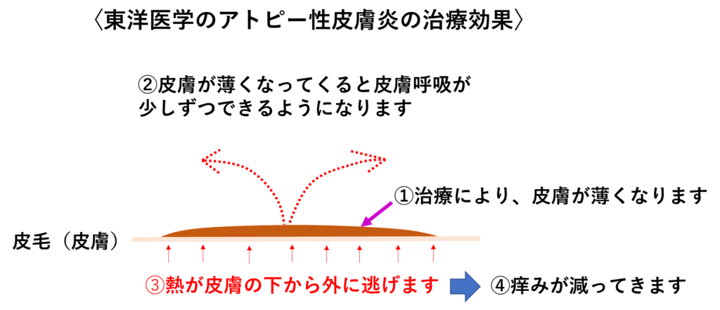 アトピー性皮膚炎専門の鍼灸院~皮膚の健康と、心の安心をサポートいたします~の掲載画像